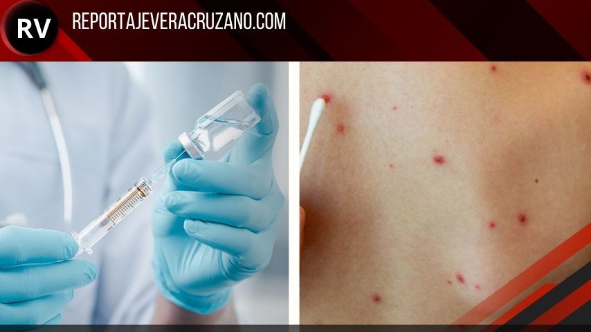 Alerta epidemiológica: Sarampión avanza en Veracruz; suman 15 casos en febrero