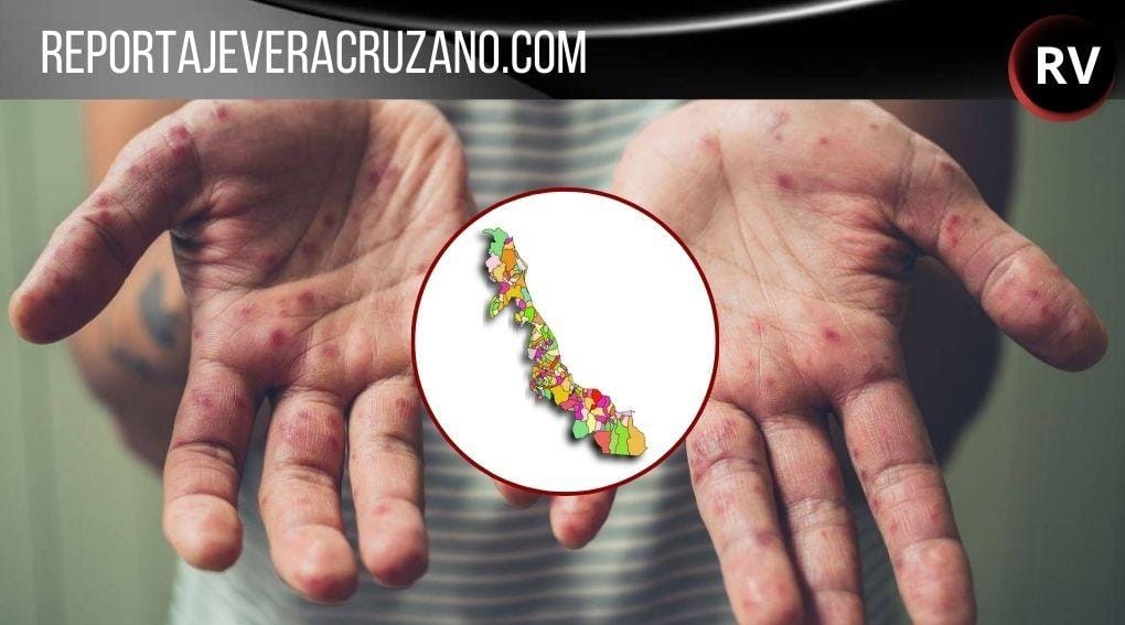 Emergencia Sanitaria: Veracruz bajo la sombra del sarampión con 6 casos confirmados