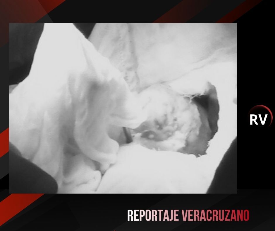 Hazaña médica en Veracruz: Realizan tercer trasplante de riñón a un mismo paciente en la UMAE