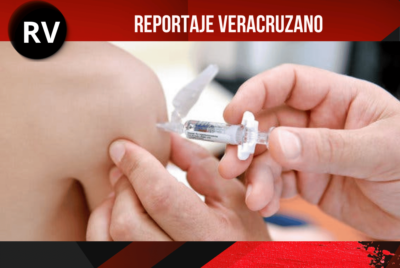 Veracruz suma 33 casos de sarampión en lo que va del 2026; tasa de incidencia es de 0.41